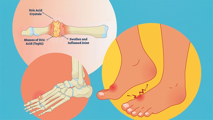 A Holistic Approach To Healing Gout